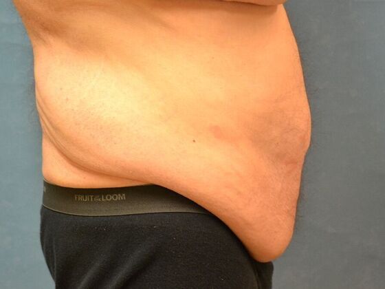 Tummy Tuck: Case 1805- Liberty Center, OH - Before
