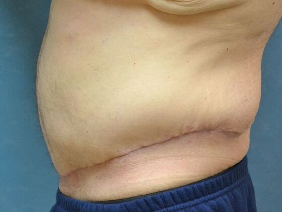 Tummy Tuck: Case 1805- Liberty Center, OH - After