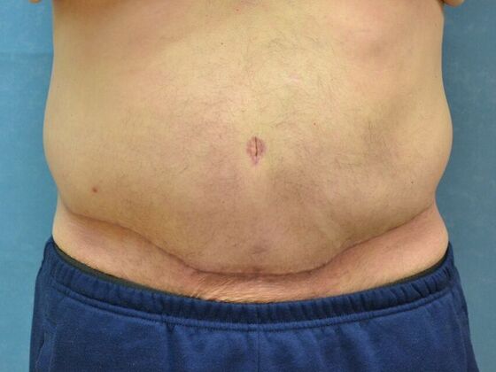 Tummy Tuck Case 1805- Liberty Center, OH - After