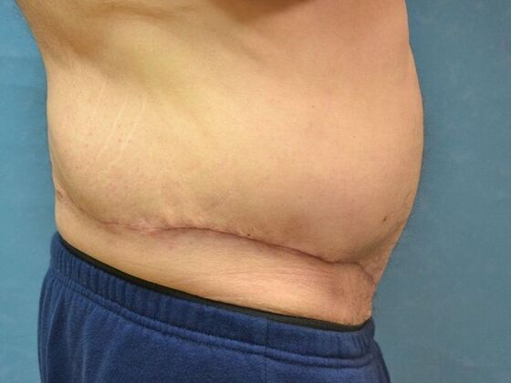 Tummy Tuck: Case 1805- Liberty Center, OH - After