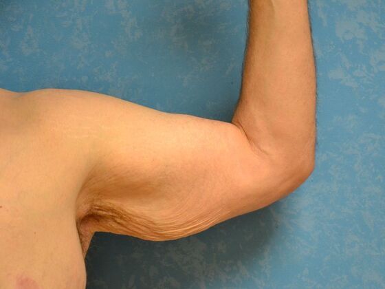 Arm Lift: Case 1511- Liberty Center, OH - Before