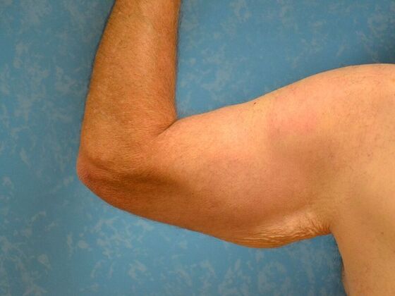 Arm Lift: Case 1511- Liberty Center, OH - Before