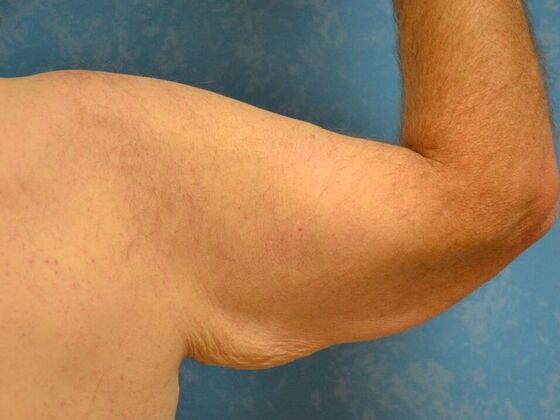 Arm Lift: Case 1511- Liberty Center, OH - Before