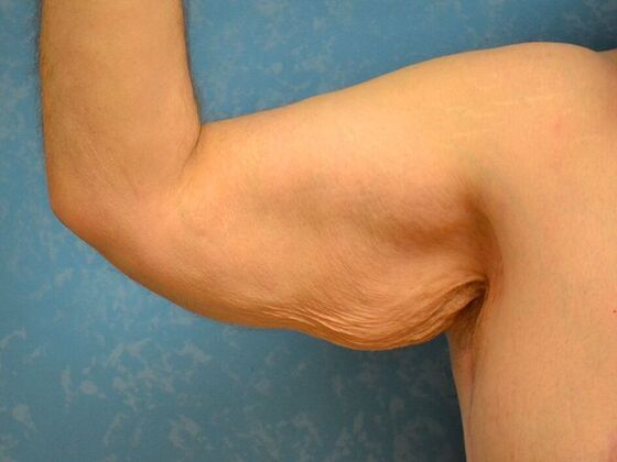 Arm Lift Case 1511- Liberty Center, OH - Before