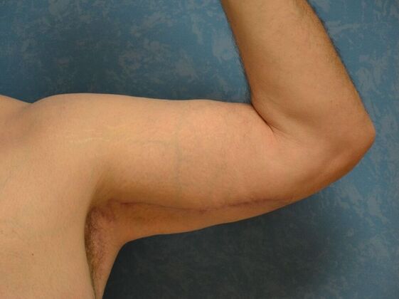 Arm Lift: Case 1511- Liberty Center, OH - After