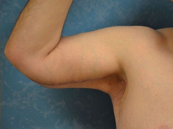 Arm Lift Case 1511- Liberty Center, OH - After