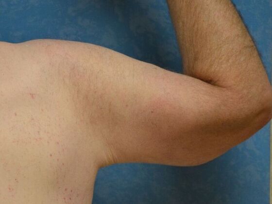 Arm Lift: Case 1511- Liberty Center, OH - After