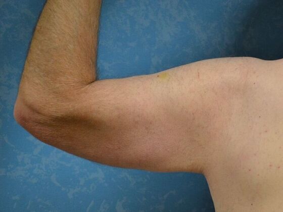 Arm Lift: Case 1511- Liberty Center, OH - After