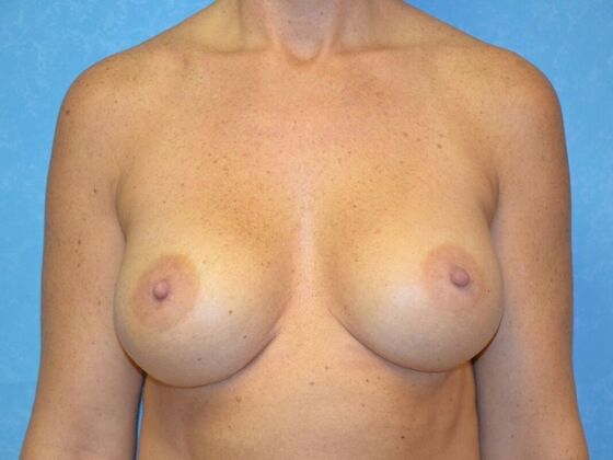 Breast Augmentation Case 1372- Oregon, OH - After