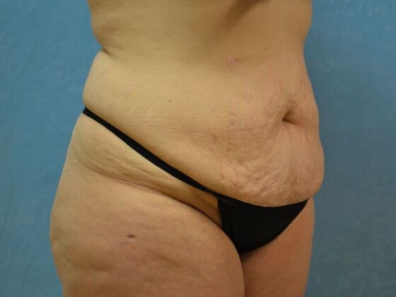 Tummy Tuck: Case 1806- Findlay, OH - Before
