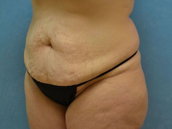 Tummy Tuck: Case 1806- Findlay, OH - Before