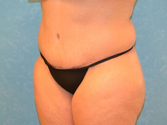 Tummy Tuck: Case 1806- Findlay, OH - After