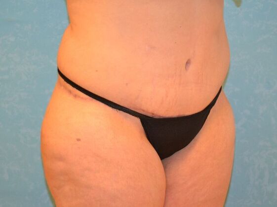Tummy Tuck: Case 1806- Findlay, OH - After