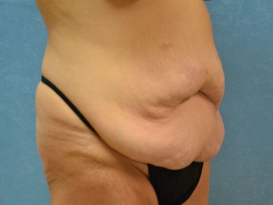 Bodylift: Case 1617- Perrysburg, OH - Before