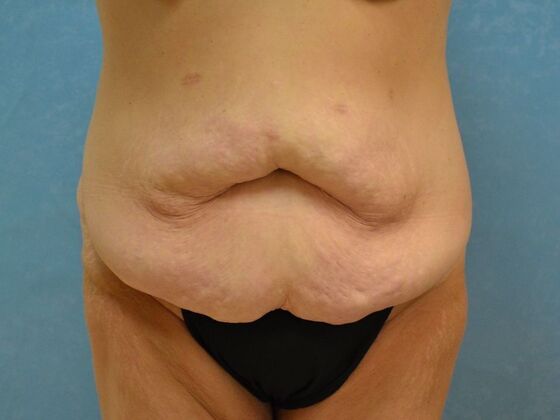 Bodylift Case 1617- Perrysburg, OH - Before