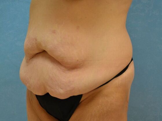 Bodylift: Case 1617- Perrysburg, OH - Before