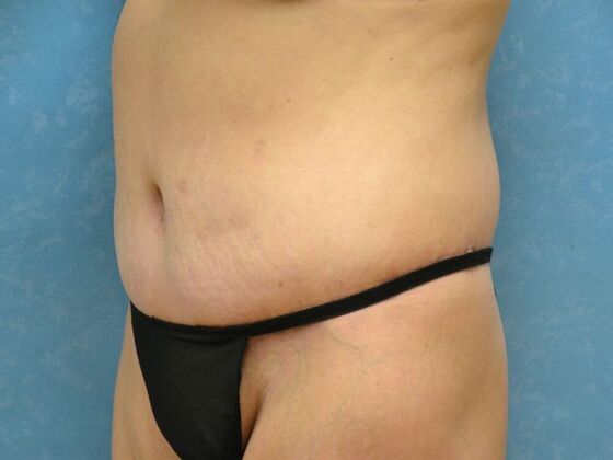 Bodylift: Case 1617- Perrysburg, OH - After