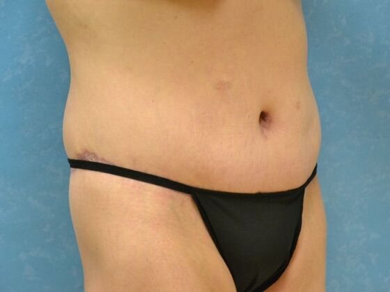 Bodylift: Case 1617- Perrysburg, OH - After