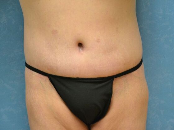 Bodylift Case 1617- Perrysburg, OH - After