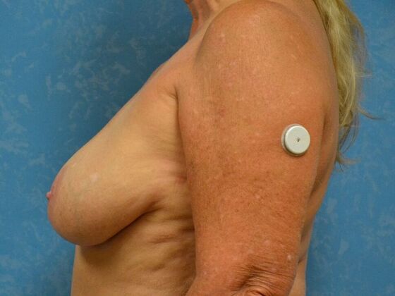 Breast Lift: Case 1502- Lyons, OH - After