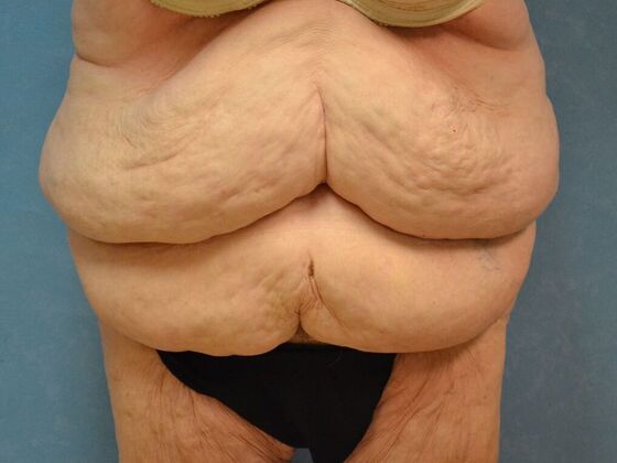 Bodylift Case 1618- Cement City, MI - Before