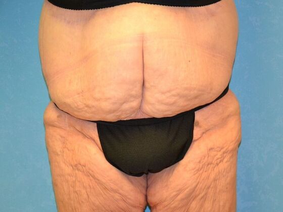 Bodylift Case 1618- Cement City, MI - After