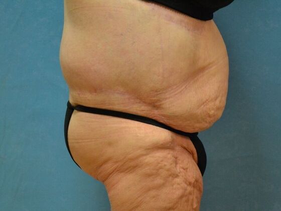 Bodylift: Case 1618- Cement City, MI - After