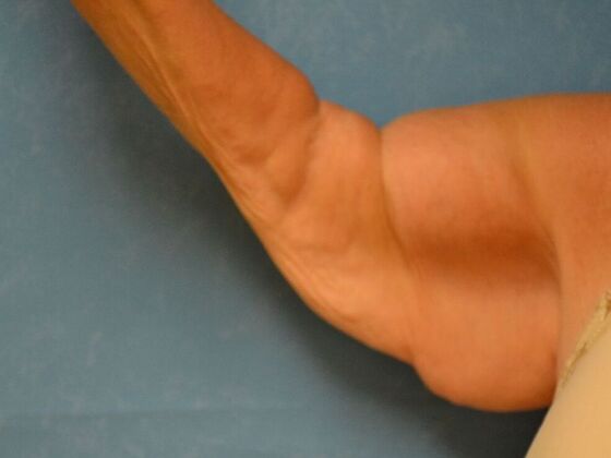 Arm Lift Case 1512- Cement City, MI - Before