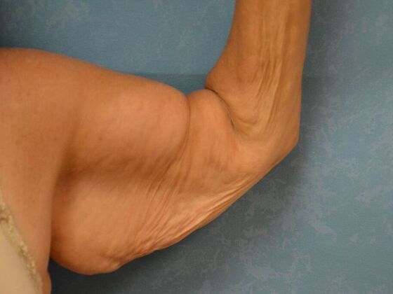 Arm Lift: Case 1512- Cement City, MI - Before