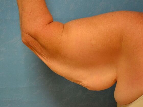 Arm Lift: Case 1512- Cement City, MI - Before