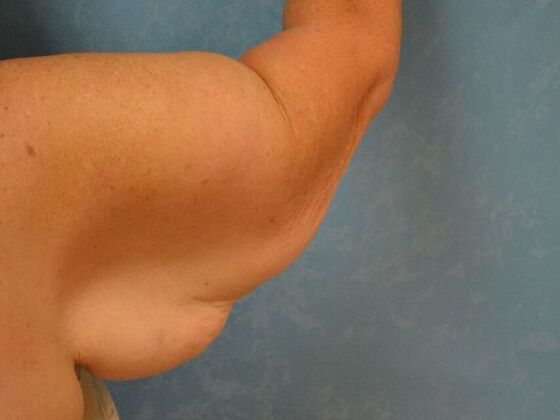 Arm Lift: Case 1512- Cement City, MI - Before