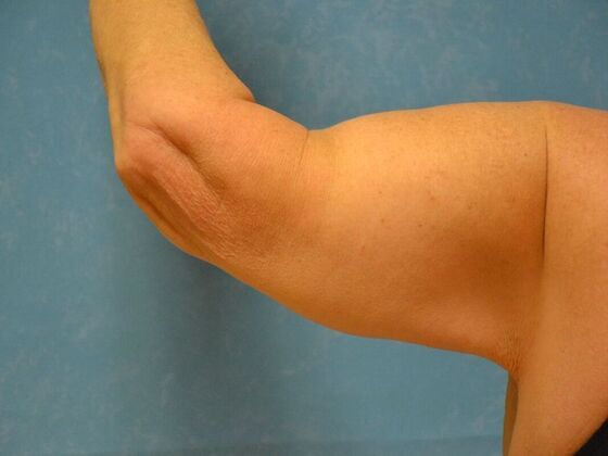 Arm Lift: Case 1512- Cement City, MI - After