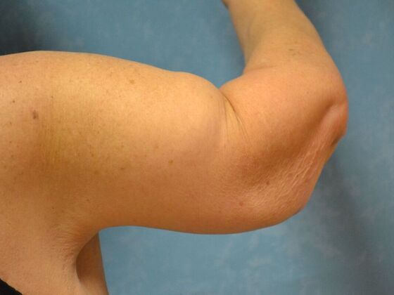 Arm Lift: Case 1512- Cement City, MI - After