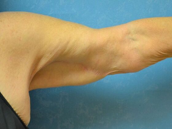 Arm Lift: Case 1512- Cement City, MI - After