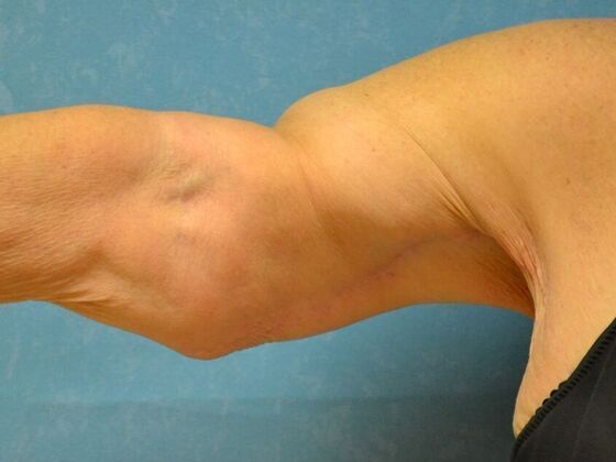 Arm Lift Case 1512- Cement City, MI - After