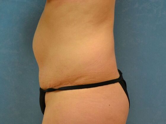 Tummy Tuck: Case 1809- Cygnet, OH - Before