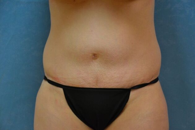 Tummy Tuck: Case 1809- Cygnet, OH - Before