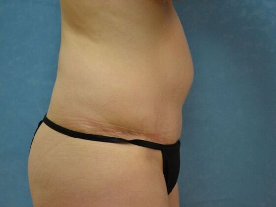 Tummy Tuck: Case 1809- Cygnet, OH - Before