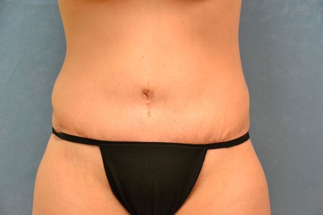 Tummy Tuck: Case 1809- Cygnet, OH - After