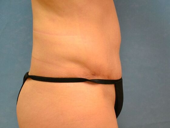 Tummy Tuck: Case 1809- Cygnet, OH - After