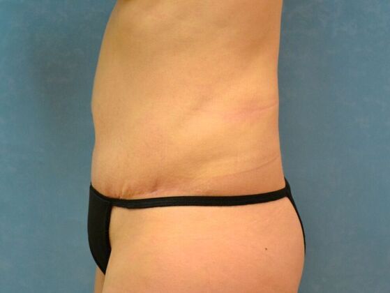 Tummy Tuck: Case 1809- Cygnet, OH - After