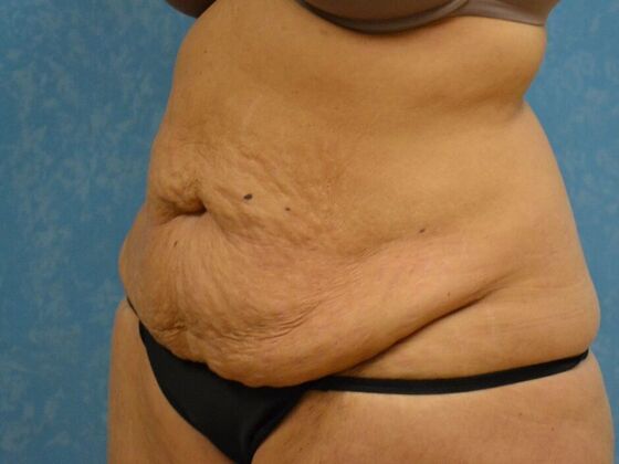 Tummy Tuck: Case 1810- Toledo, OH - Before