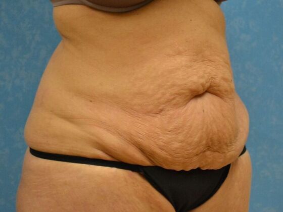 Tummy Tuck: Case 1810- Toledo, OH - Before