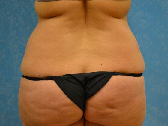 Tummy Tuck: Case 1810- Toledo, OH - Before