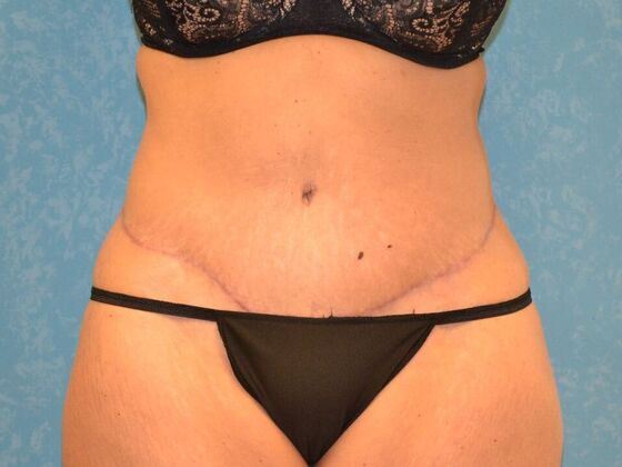 Tummy Tuck Case 1810- Toledo, OH - After