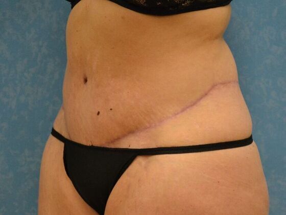 Tummy Tuck: Case 1810- Toledo, OH - After