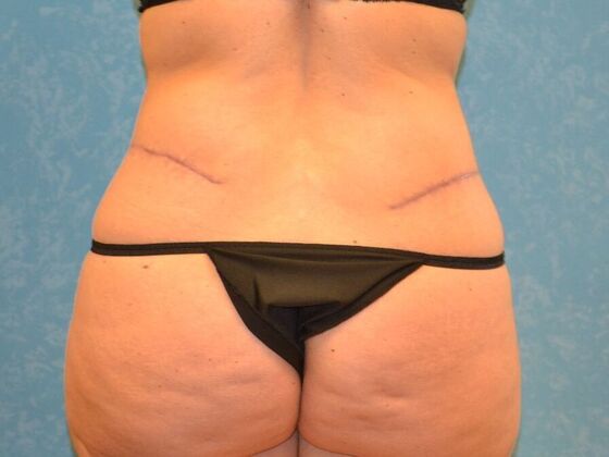 Tummy Tuck: Case 1810- Toledo, OH - After