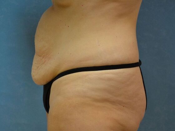 Tummy Tuck: Case 1811- Lyons, OH - Before