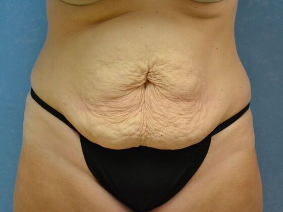 Tummy Tuck: Case 1811- Lyons, OH - Before