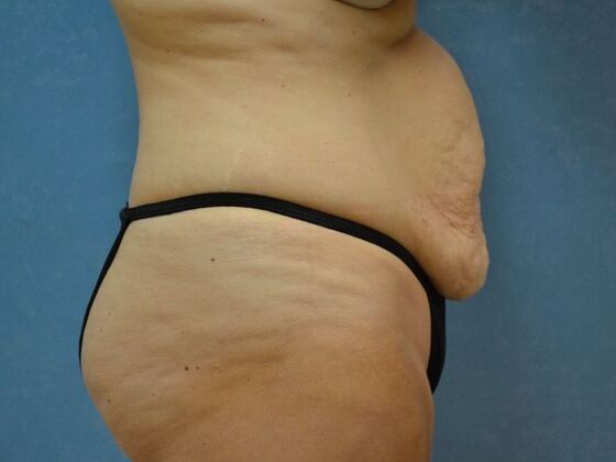 Tummy Tuck: Case 1811- Lyons, OH - Before